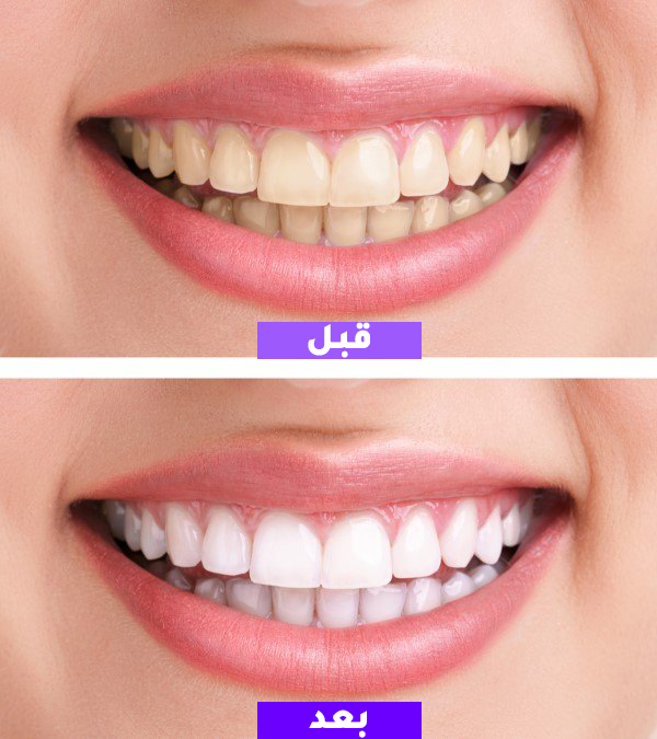 جل تبييض الأسنان  – لابتسامة بيضاء وانتعاش يدوم